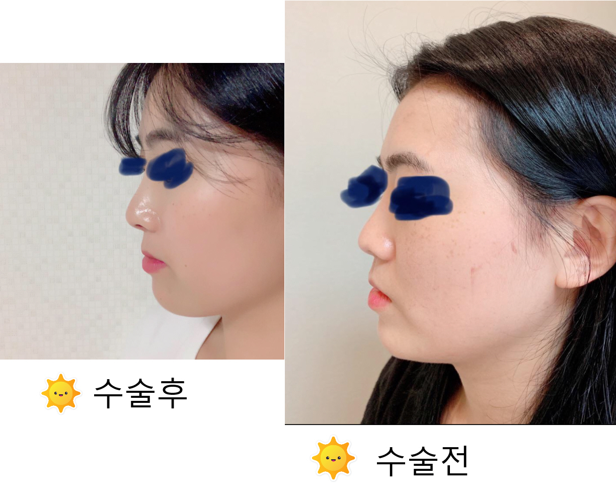 무보형 코수술