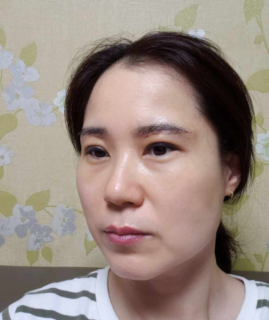 회복이 빨라 더욱 만족스러운 눈썹거상·자연유착 2주차