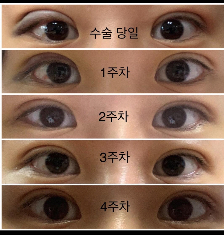 자연유착 수술후기