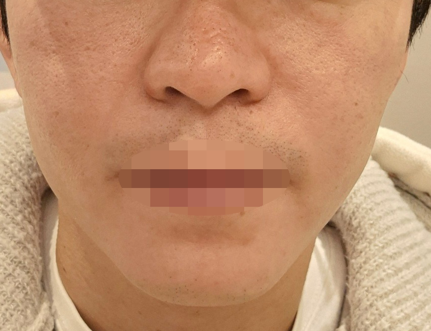 피부 거칠어서 인모드 받았는데 너무 좋아진 것 같아 만족합니다.