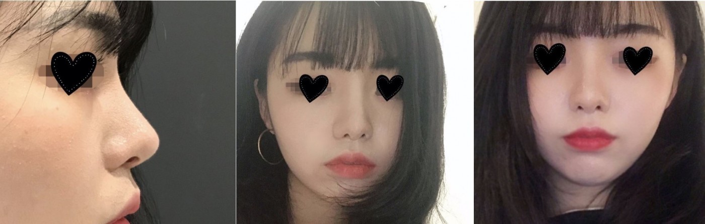 코수술 3개월차!