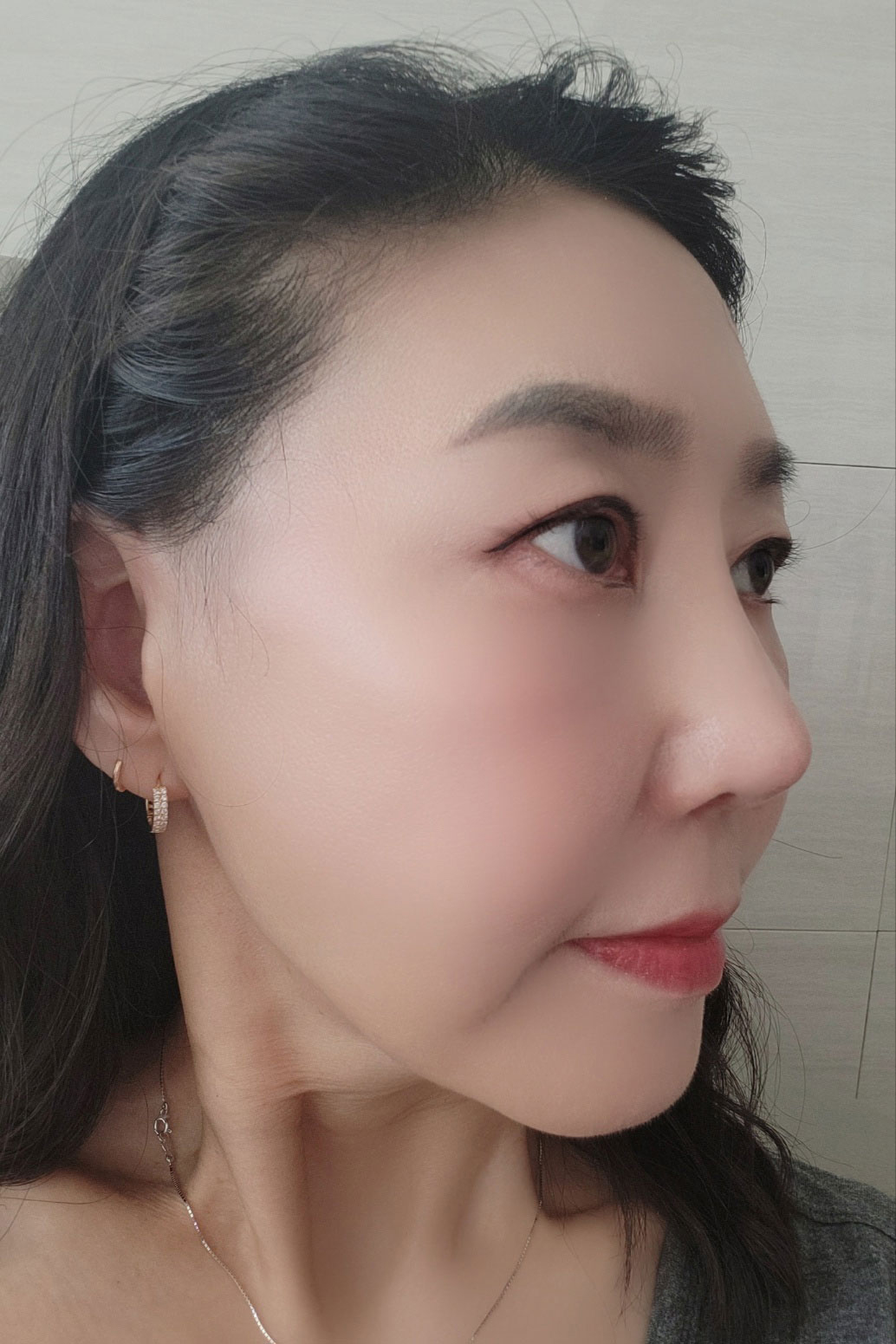 재수술 받은지 한달차입니다