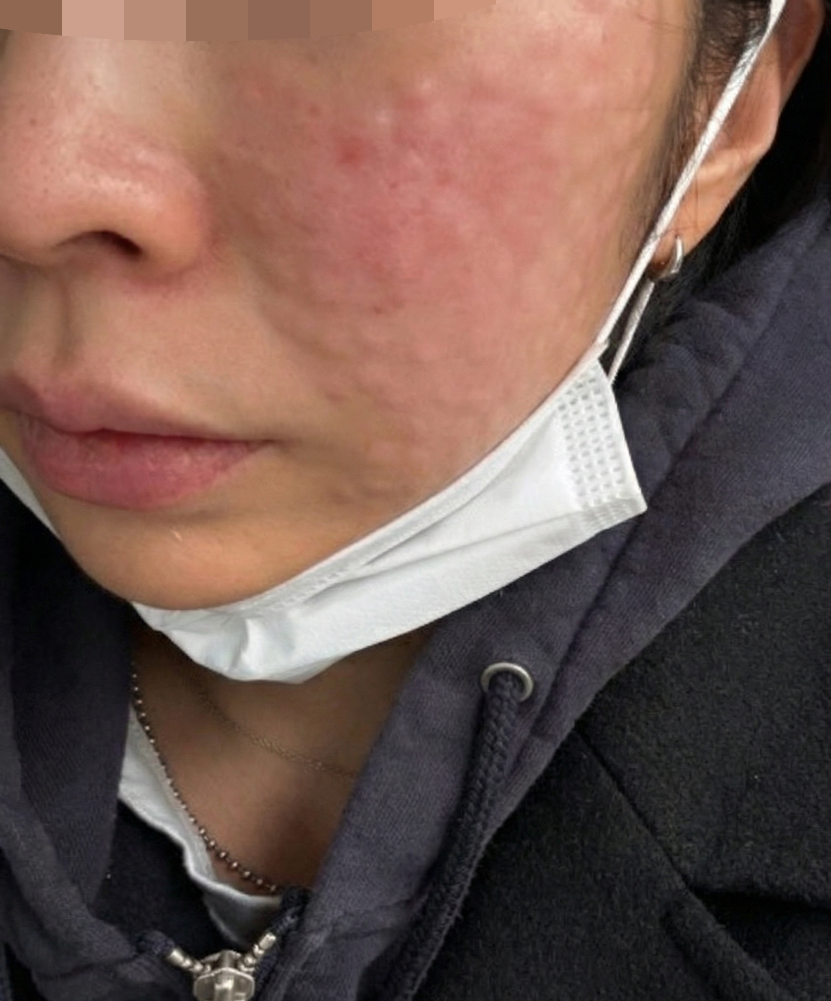 쾌적한 분위기에서 수면 리쥬란 편하게 받았어요~