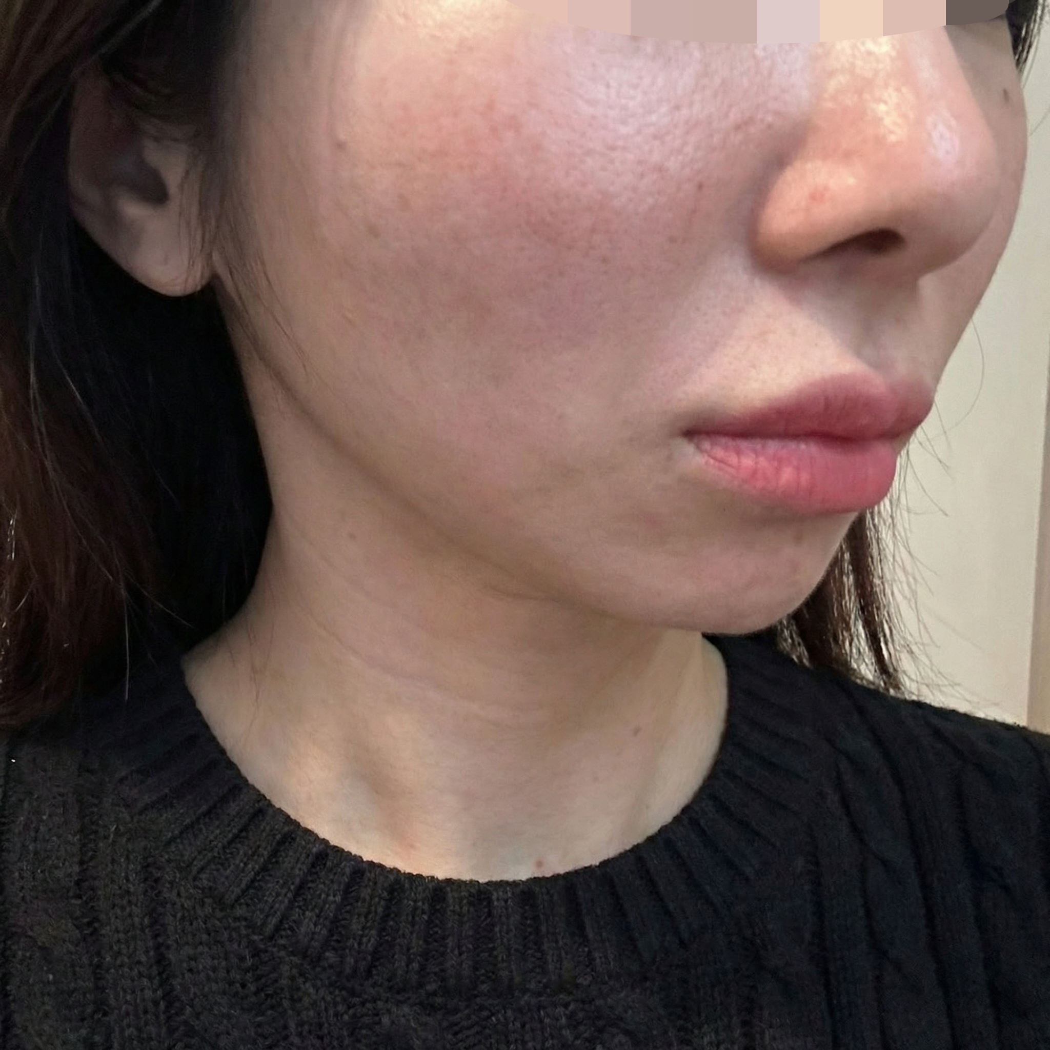 여드름 흉터 고민이라 쥬베룩이랑 연어주사 같이 맞아봤어요!