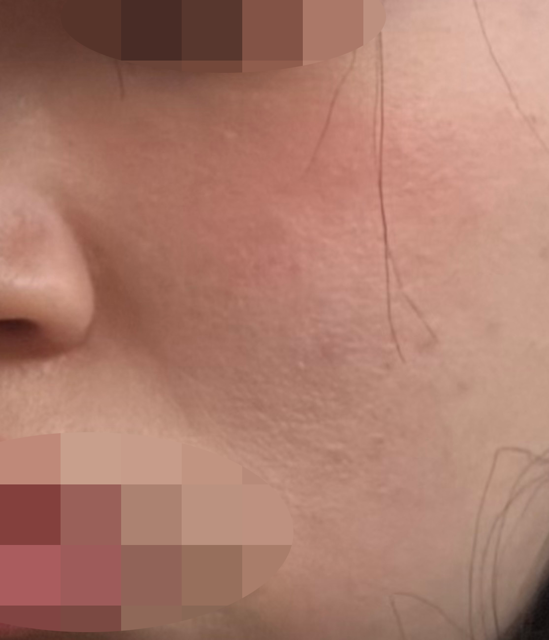 피부 당김 때문에 받았는데 만족스러워서 재방문 예정이에요!