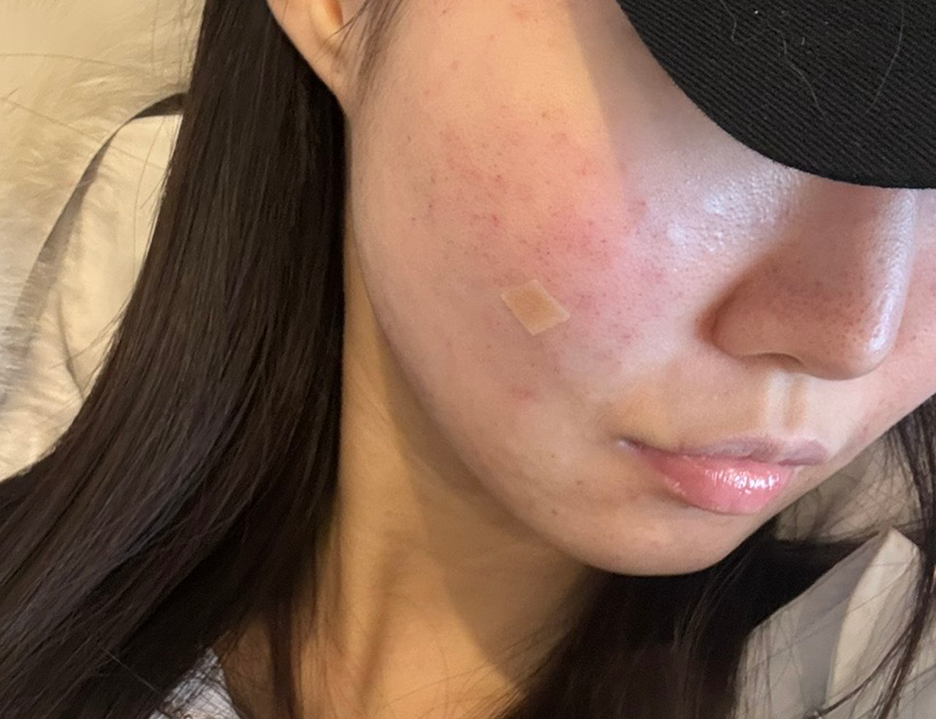 곧 결혼식 앞두고 왔는데 수면이라 편하게 할 수 있었고, 예산 안에서 필요한 시술만 추천해주셔서 좋았어요!