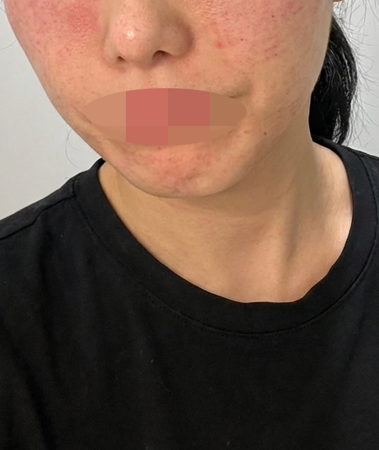 팔자주름 고민으로 쥬베룩볼륨 받아봤어요~!
