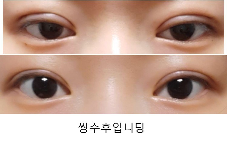 인아웃쌍수