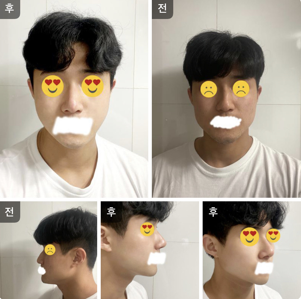 매부리 후기에염