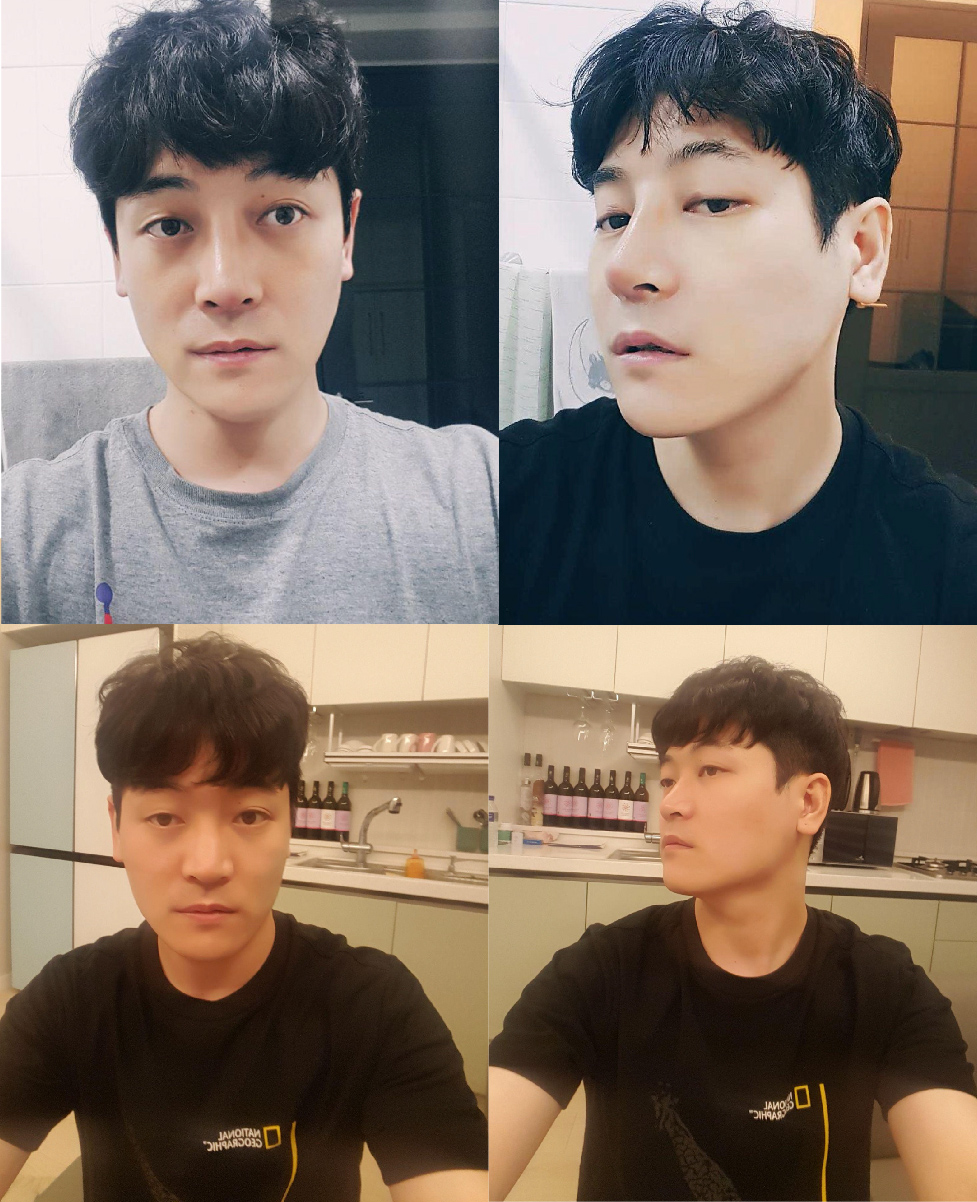 서울아이성형외과 황정일원장님께 코수술받았습니다.