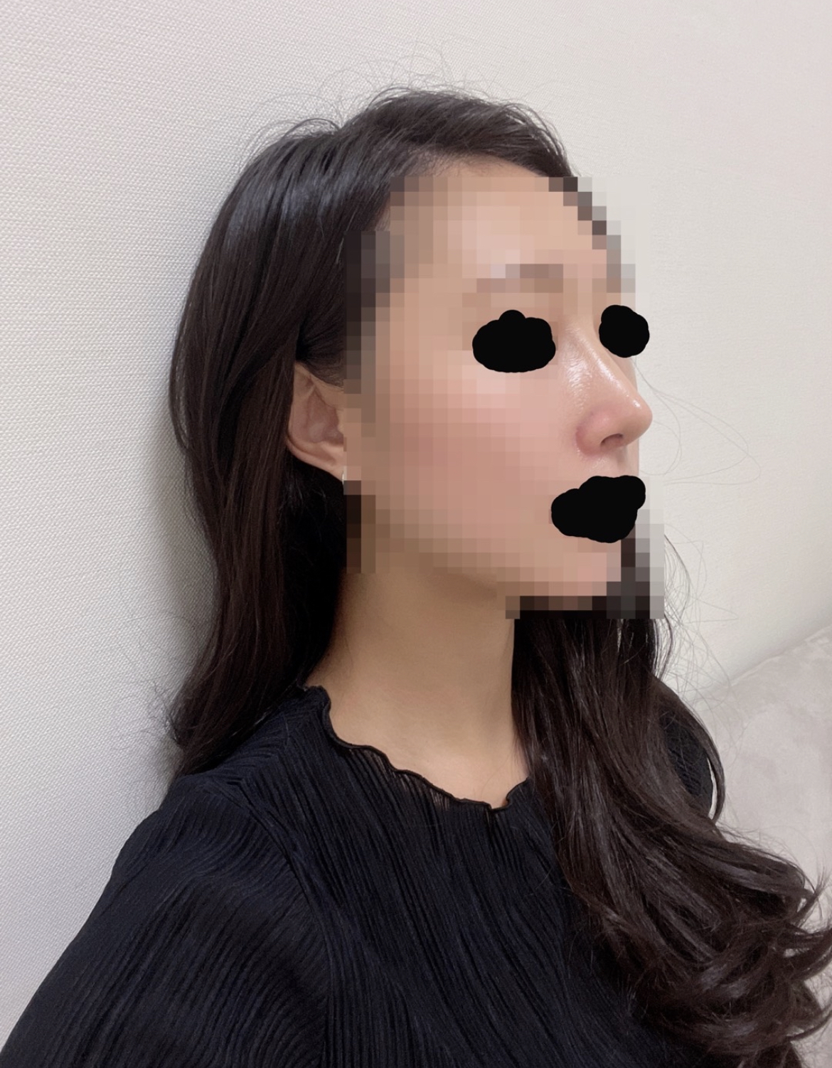 수술하고 코 라인이 너무 예뻐졌어요!