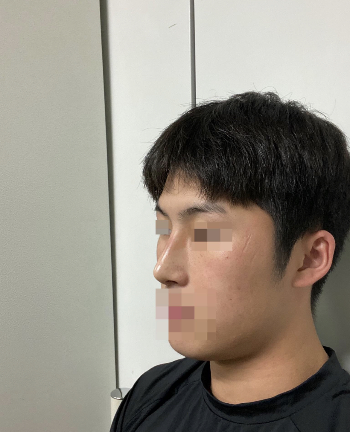 첨부한 사진은 수술 2주차 사진입니다!