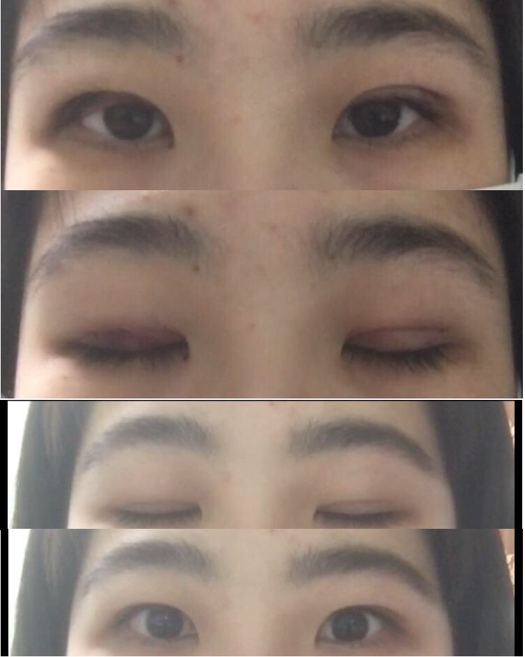 눈매교정 + 쌍꺼풀