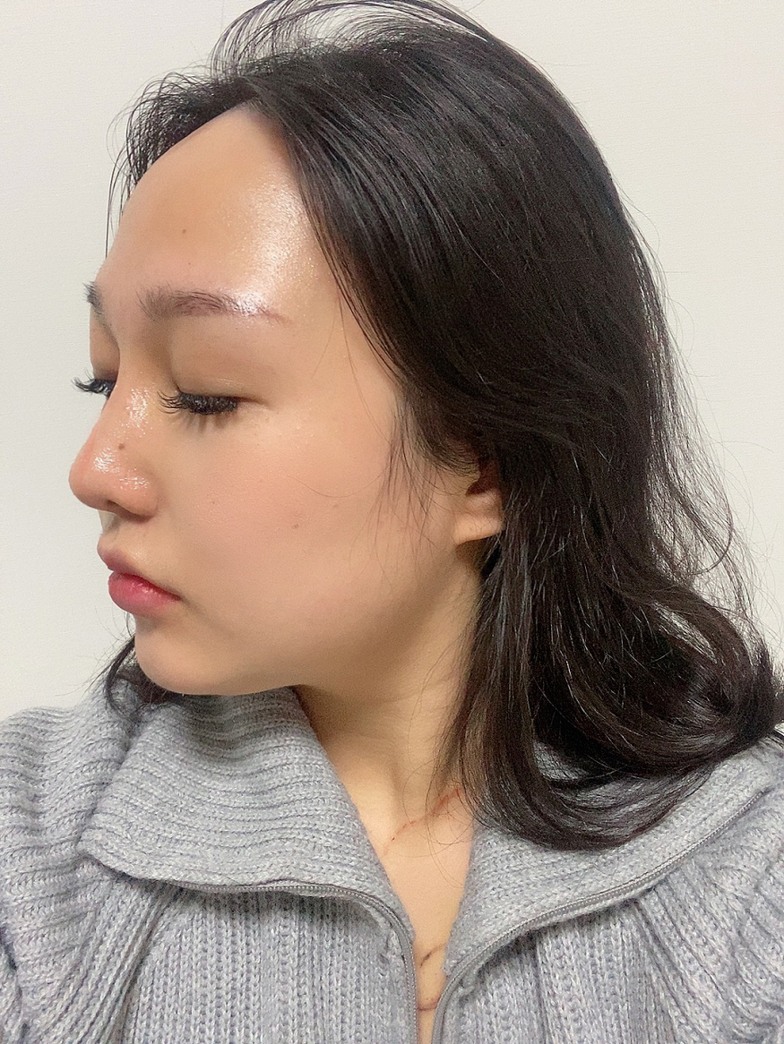 수술한지 벌써 한 달이 지났네요!
