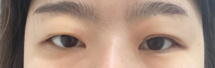 자연유착 눈매교정 - 눈재수술후기