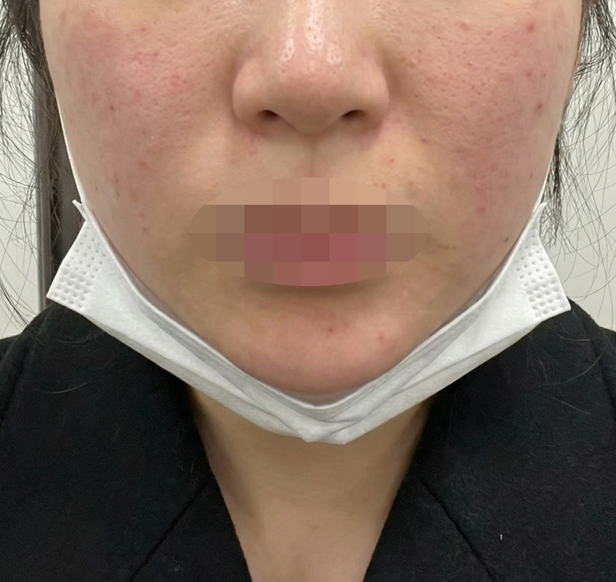 리쥬란 받았는데 효과 보이면 꾸준히 다니려고요~
