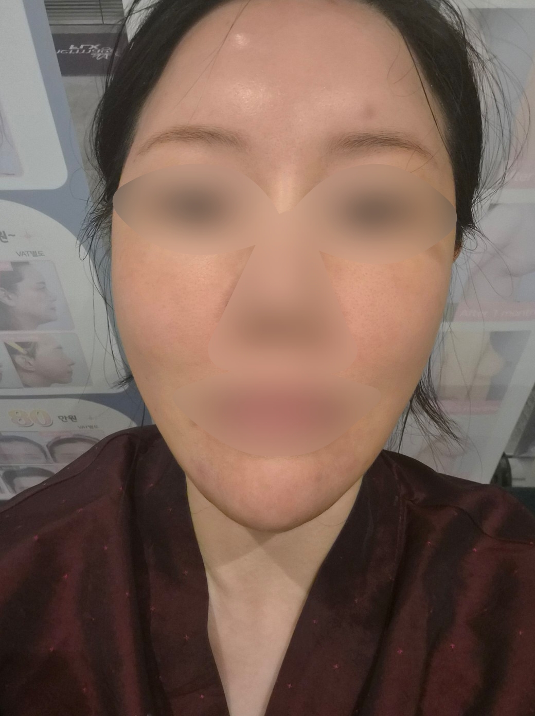 모공 고민으로 포텐자 효과 좋다길래 이 병원 선택했어요~