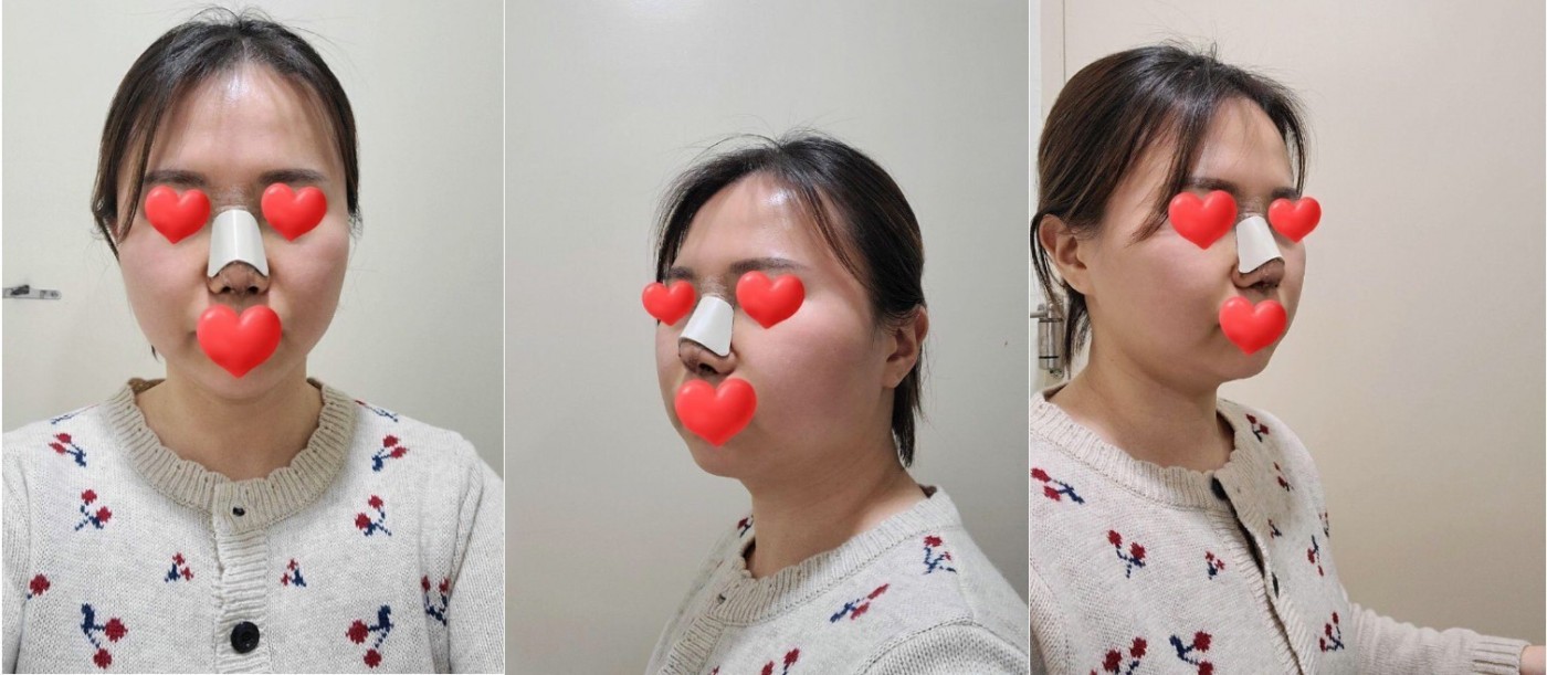 복코 성형 후기입니다.