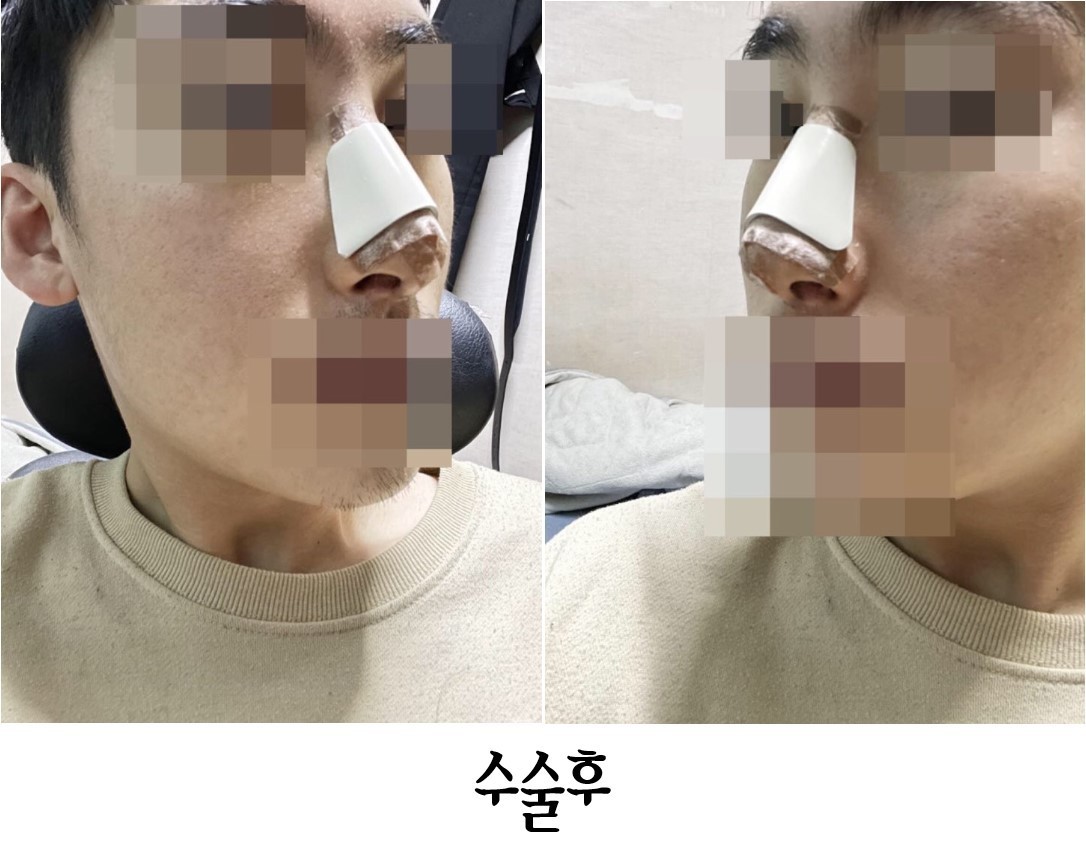 남자 코 수술 후기입니다