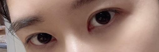 쌍꺼풀, 눈매교정, 앞트임 후기