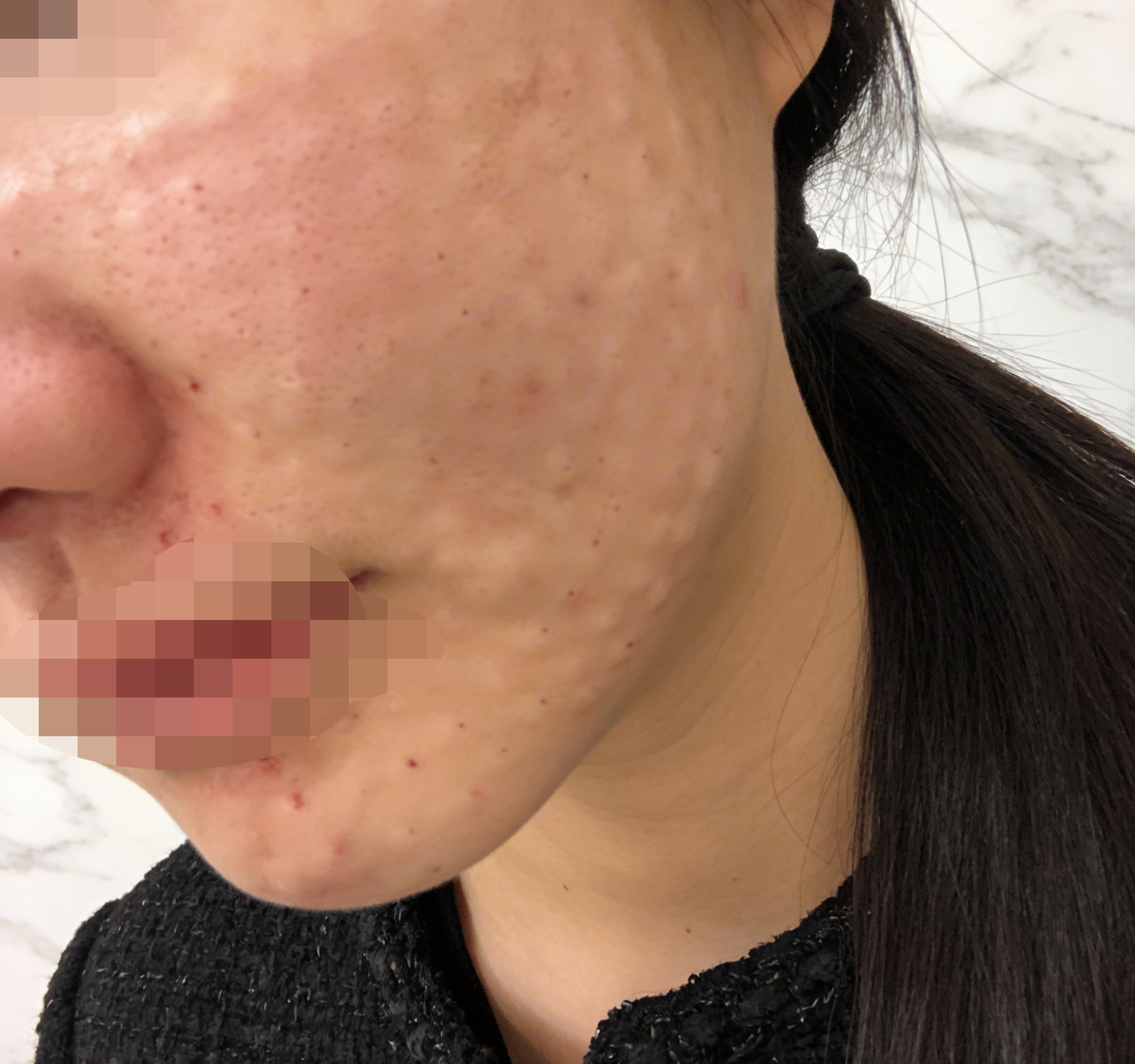 트러블 반복돼서 쥬베룩 받았는데 피부 진정되는 느낌이에요 ㅎㅎ