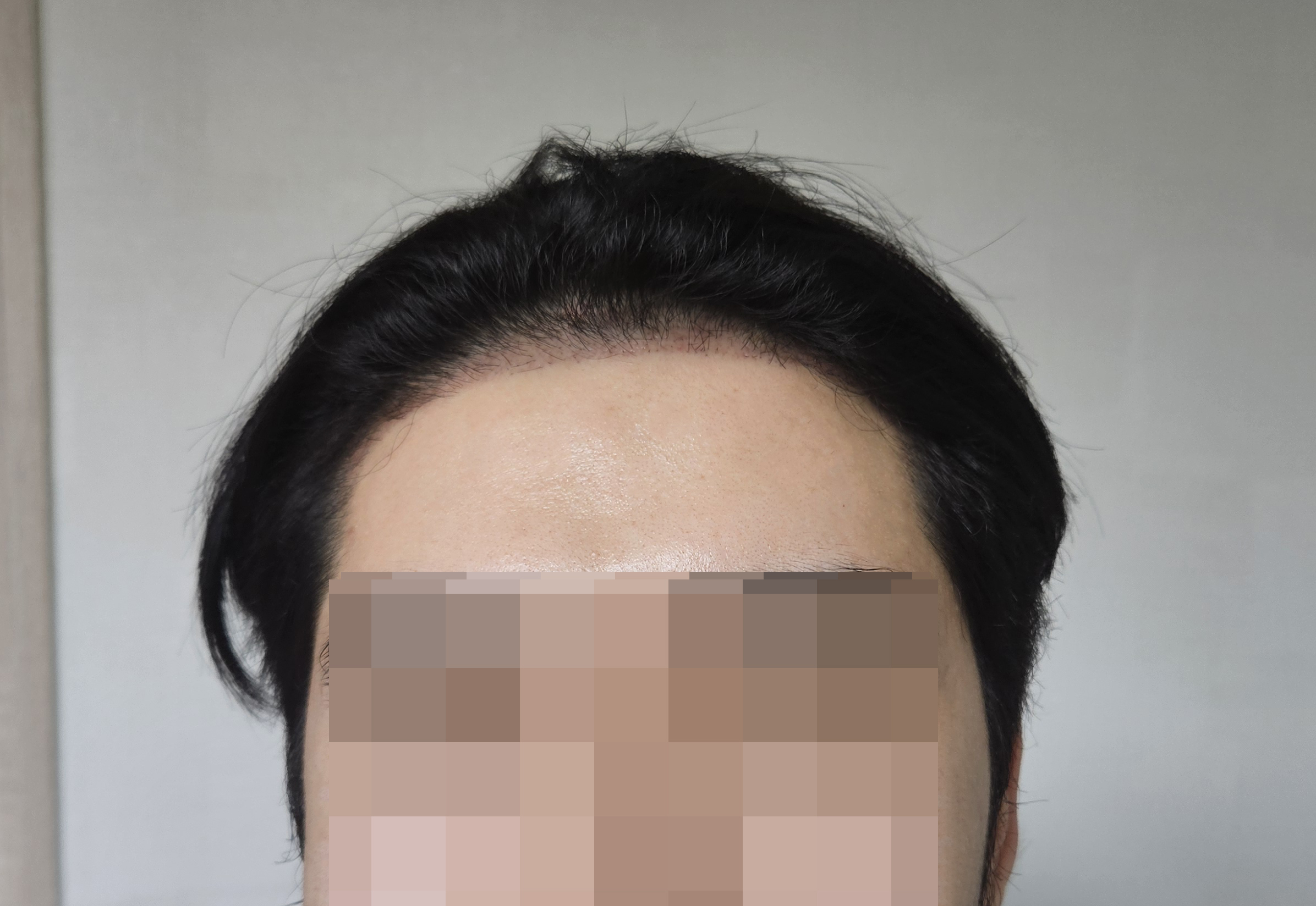 M자라인 고민하다 모발이식 받은 2주차 후기예요