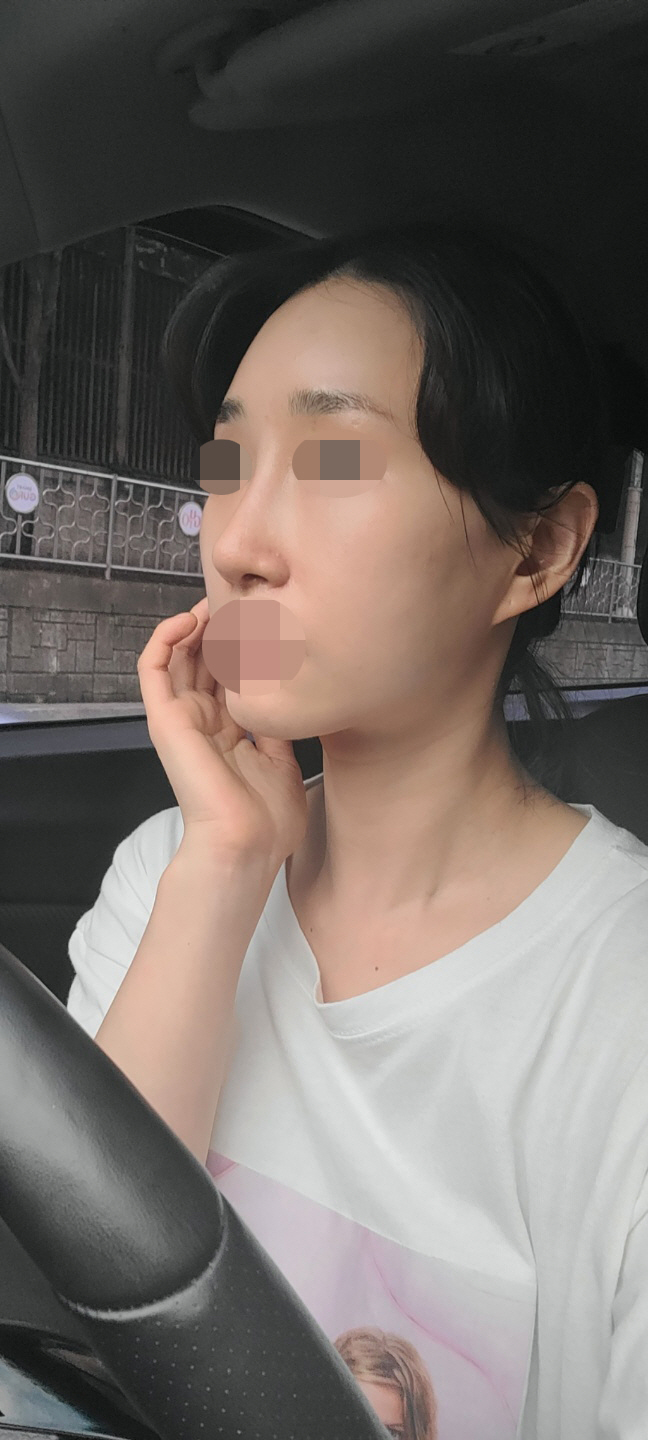 코재수술 후기좀 남겨볼래요~~~!!