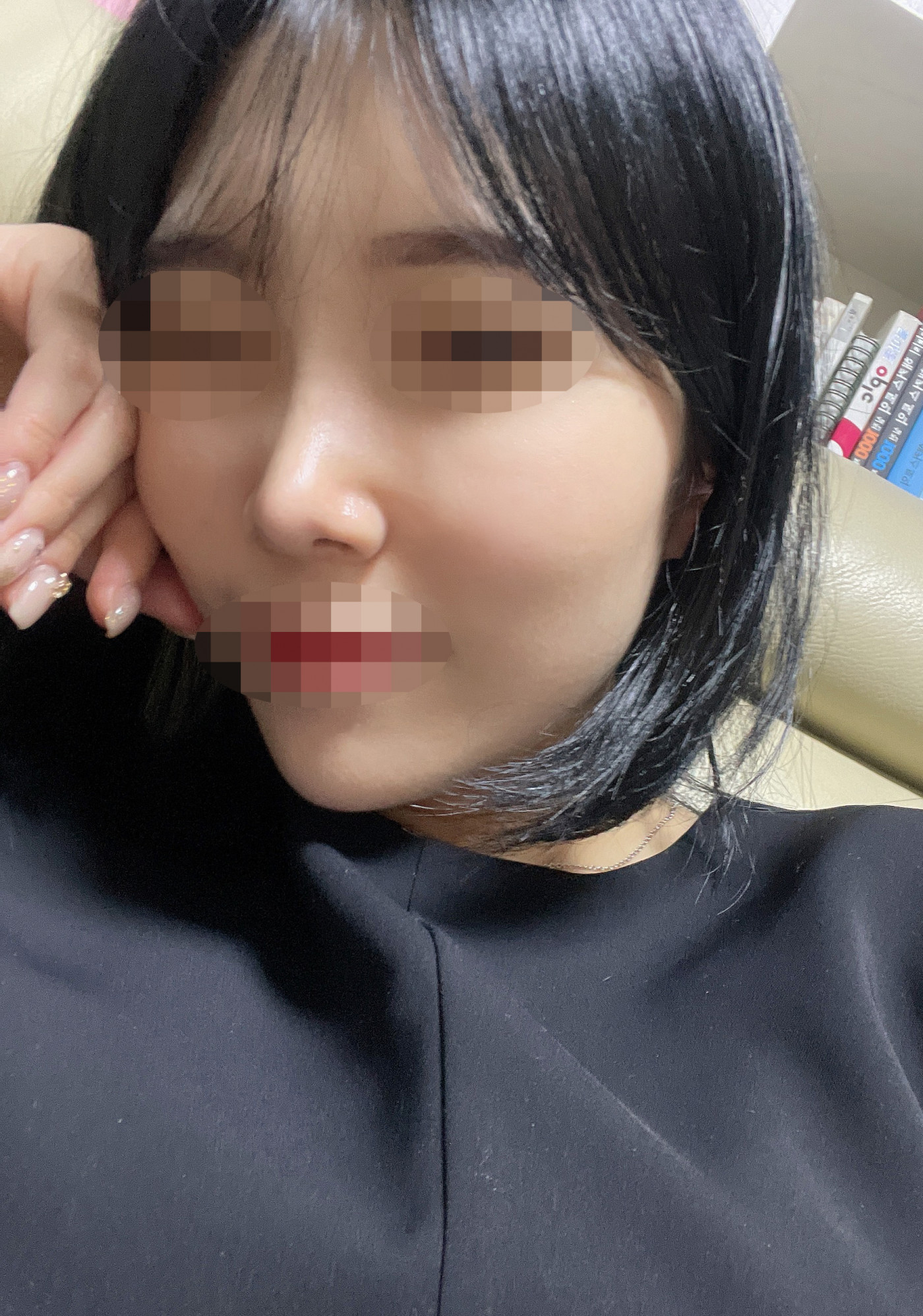 서울아이에서 코 수술하고 3개월차 후기입니다!