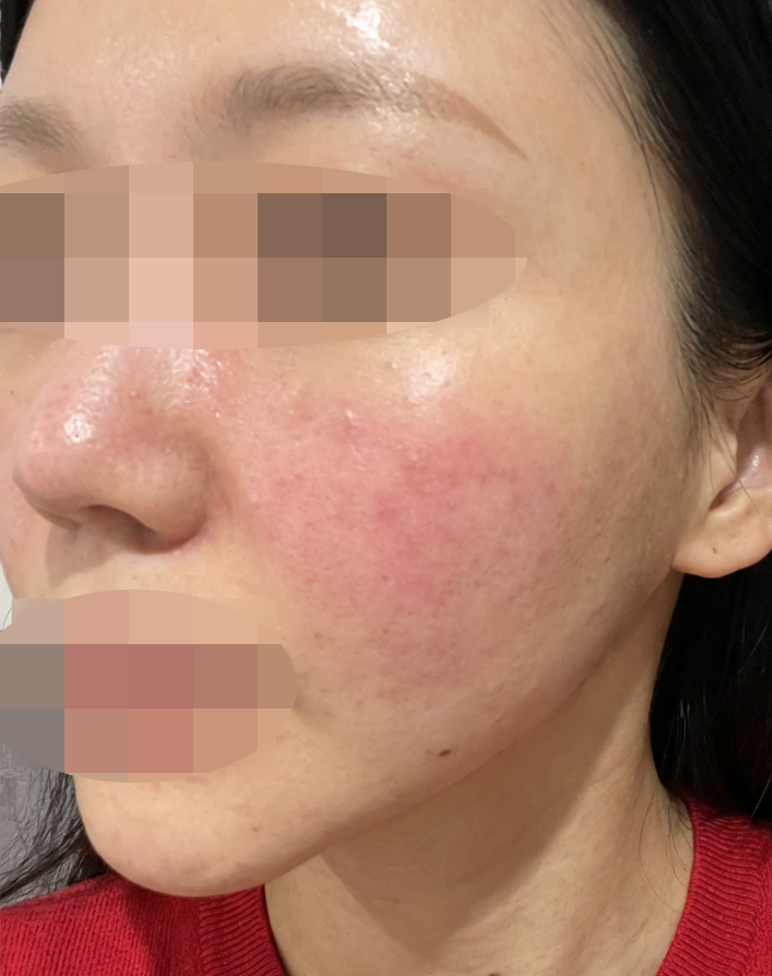 속건조랑 화장 잘 먹는 피부 유지하려고 리쥬란 또 맞으러 왔어요~