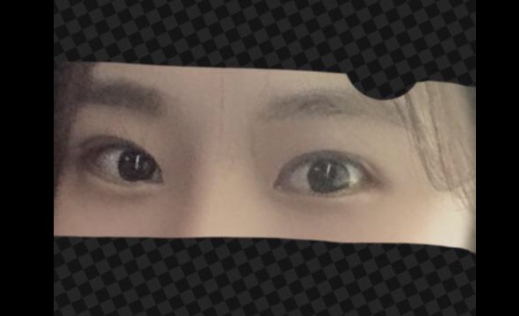뒤트임 밑트임 시술후기 :-)