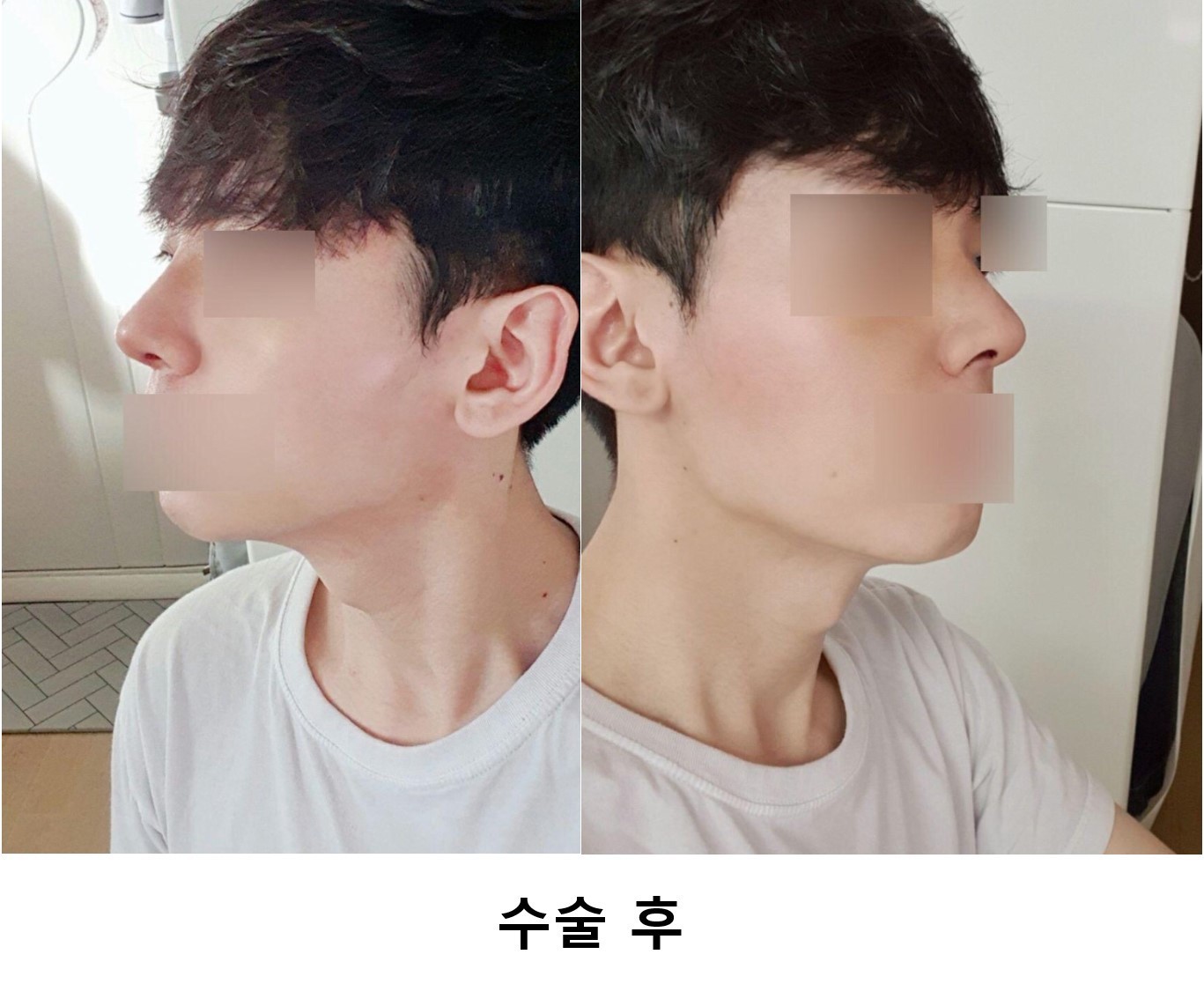 수술 후기