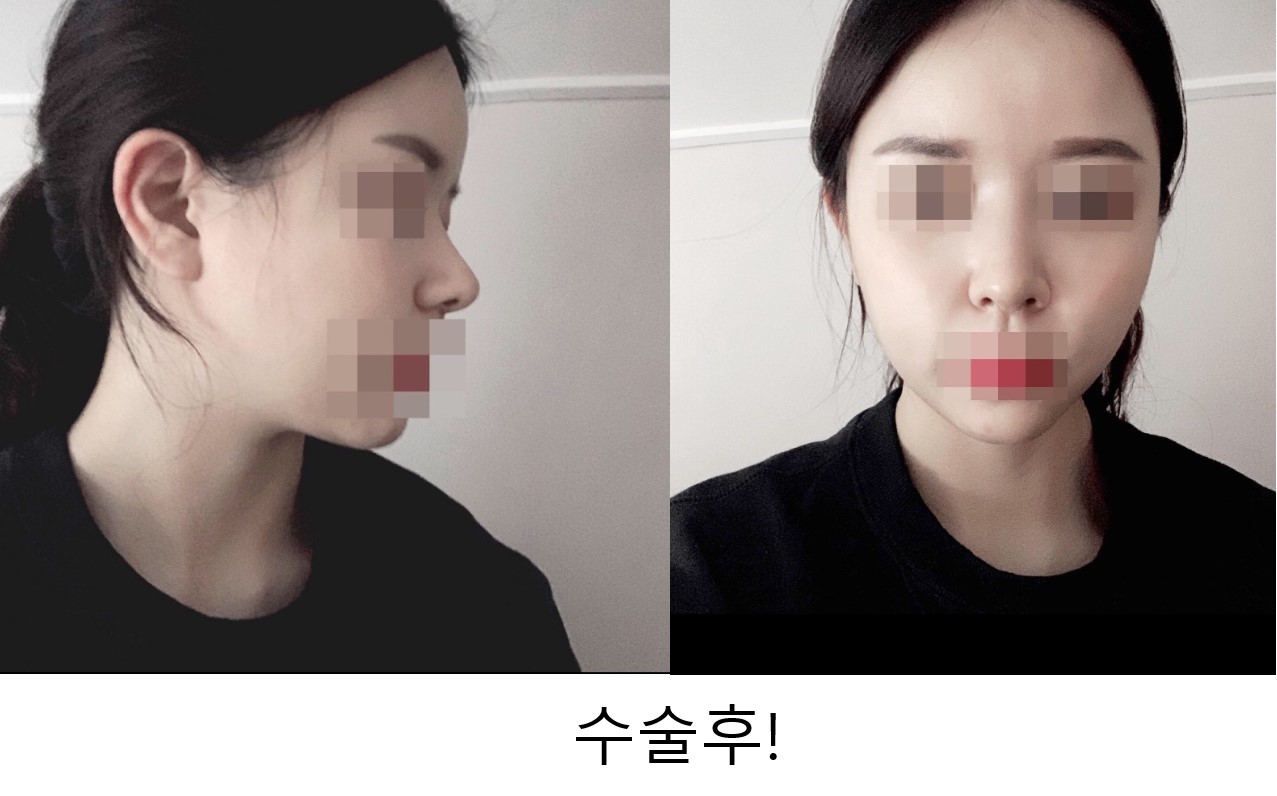 서울아이성형외과에서 코수술했어요~