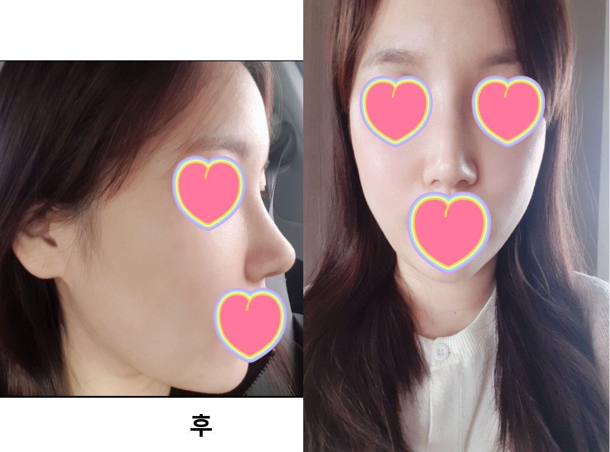 복코 수술 후기입니다