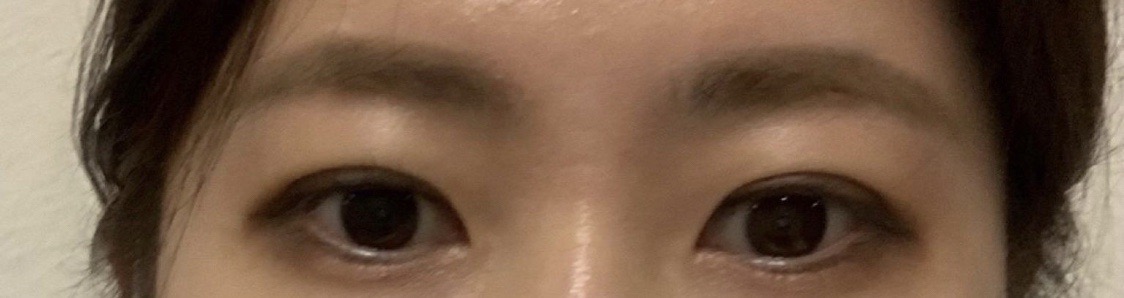 친구따라 수술한 후기입니당