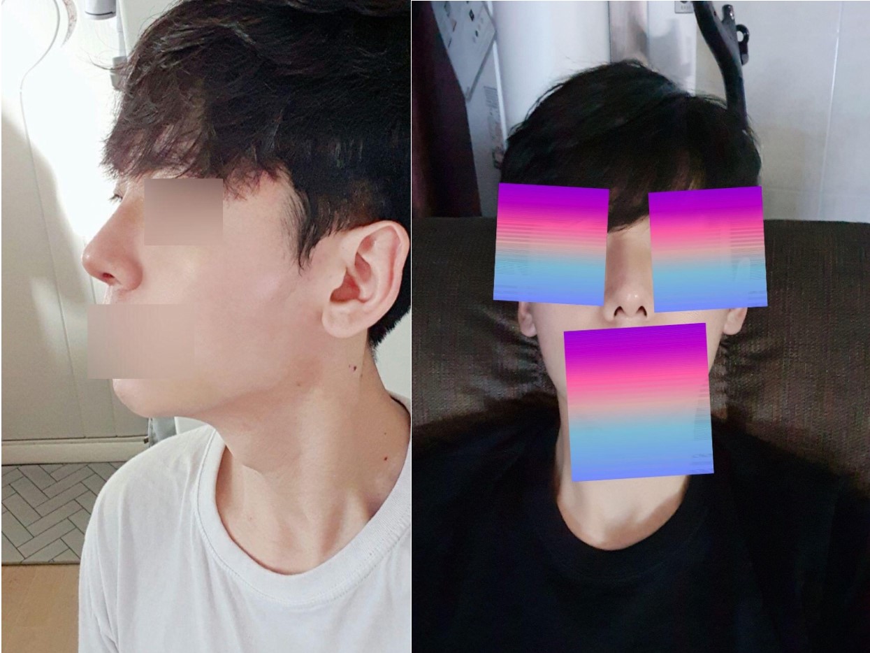 매부리코 수술 한달 반 차