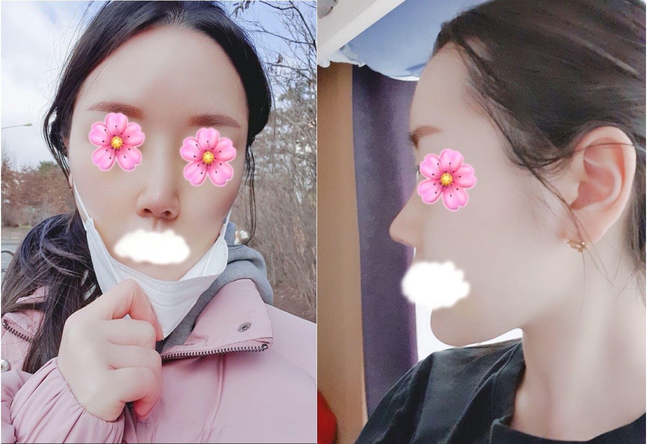 코 수술