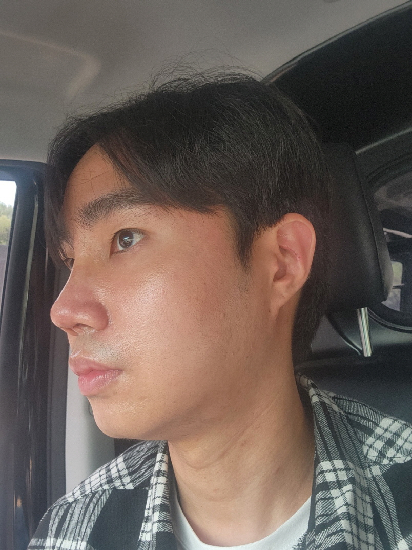 원장님 실력이 좋으시구 재수술 많이 해보신 프라이드가 엄청 있으십니다! 만족해요!