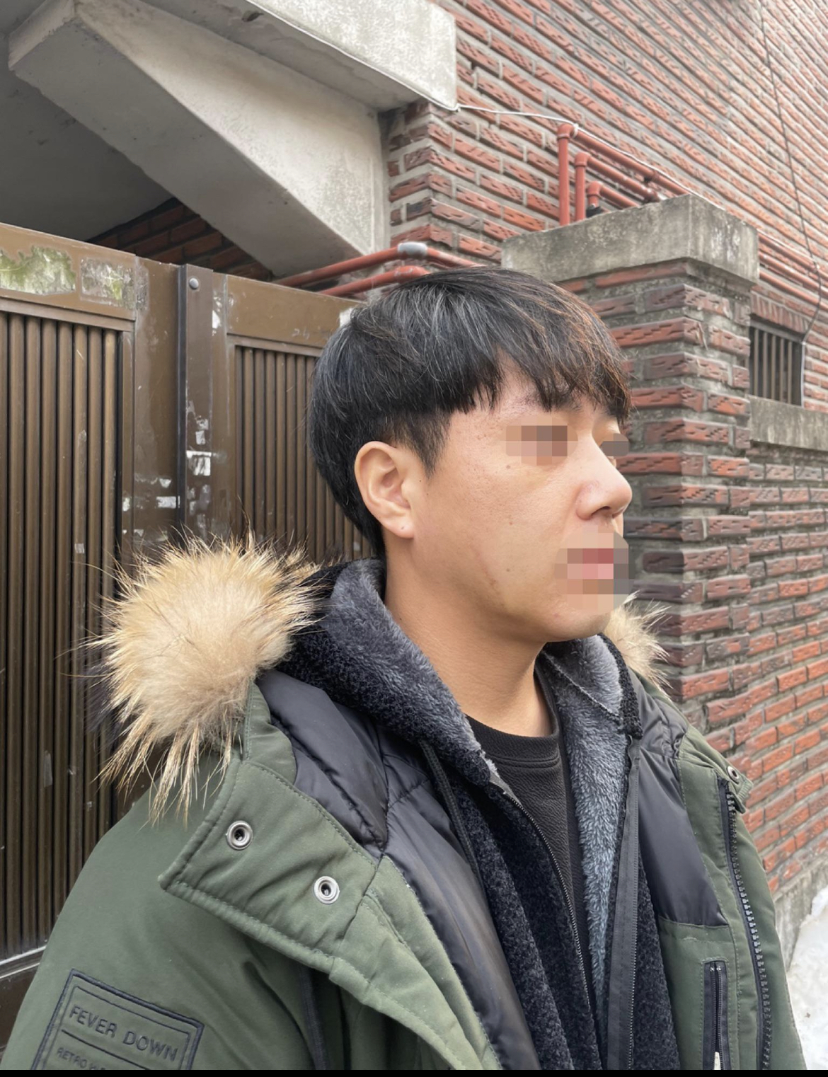 아직 2주밖에 안됐는데 붓기 살짝 빠진 모습인데 아주 만족해요 ㅎ