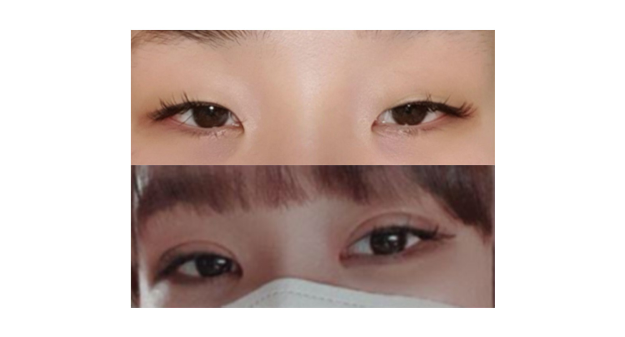 절개쌍꺼풀+앞트임+눈매교정 으로 또렷한 눈매완성