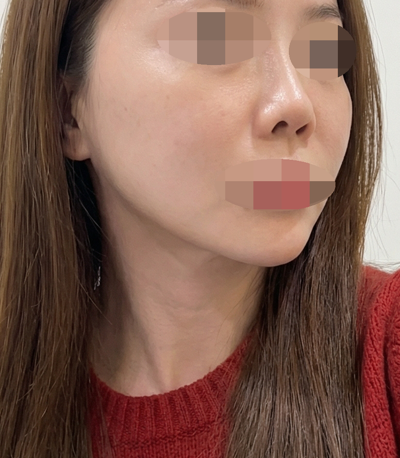 턱선 처짐 때문에 온다리프팅 받았는데 만족인 것 같아요~!