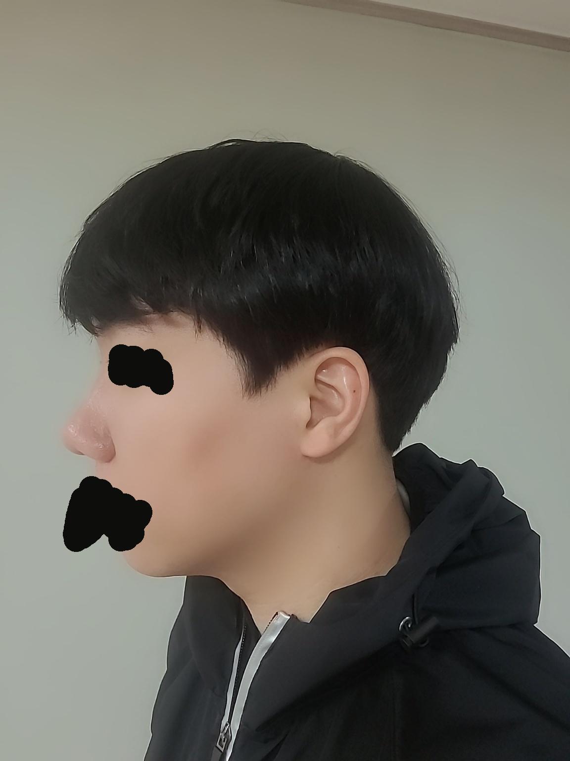 수술하고 한달차가 됐습니다.