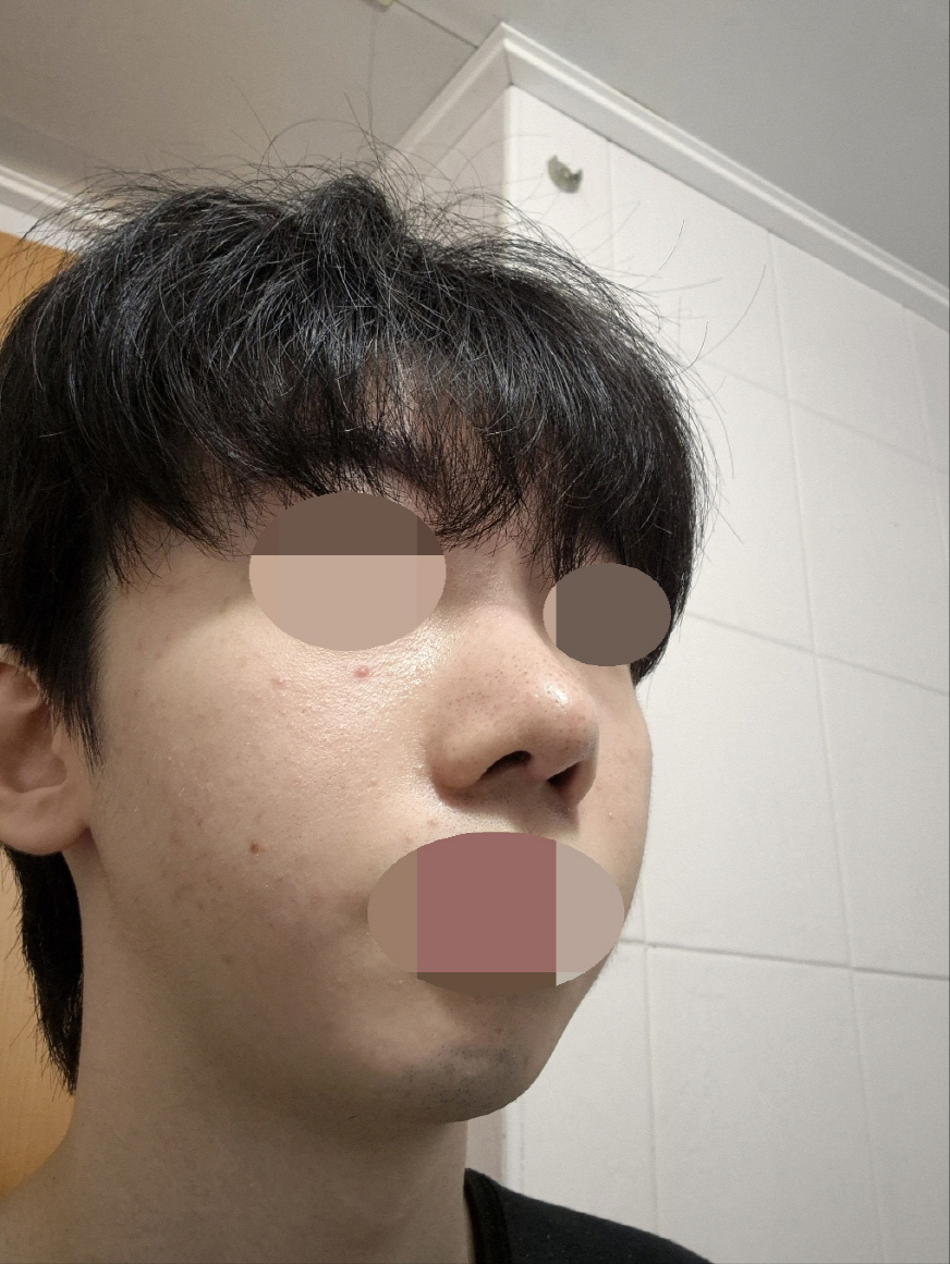 붓기도 멍도 없이 안 한거처럼 깔끔하게 교정되었습니다~