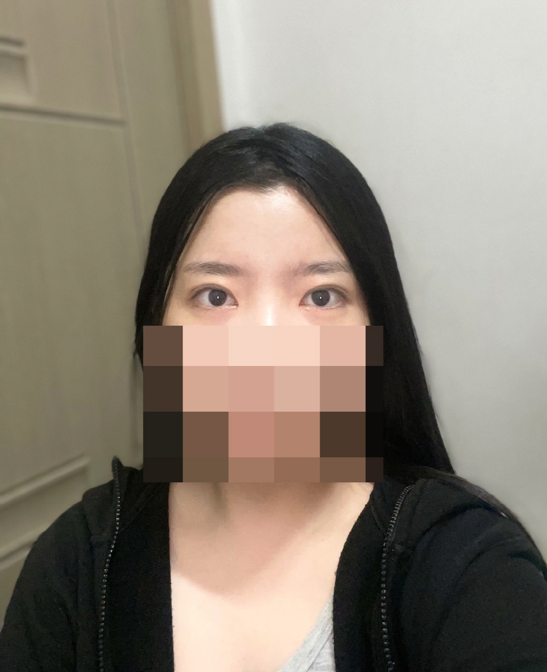 멍이랑 붓기도 많이 없고 자리 잘잡고 있어용