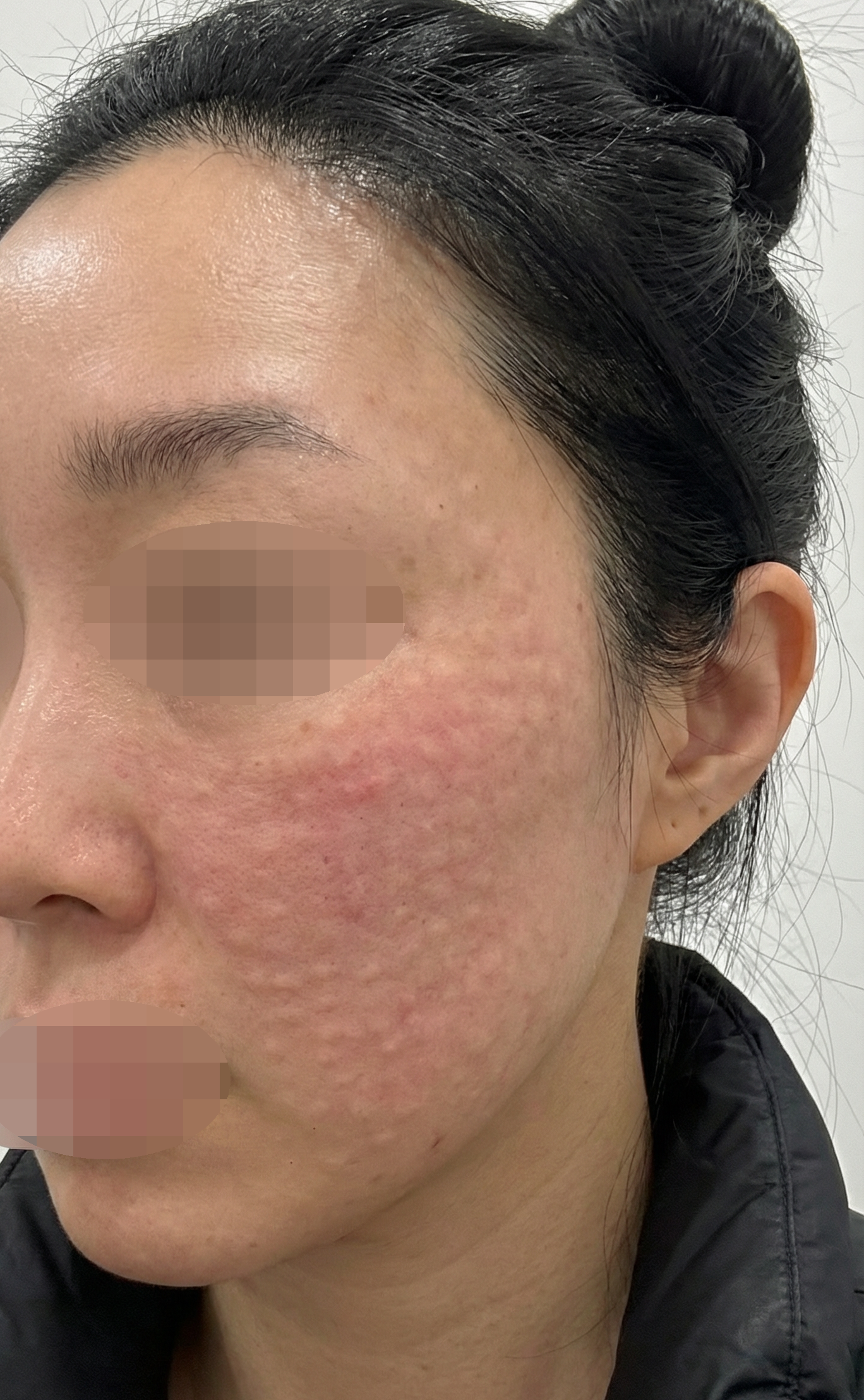   리쥬란 만족해서 또 왔는데 엠보 촘촘해서 좋았어요~ 재방문인데 역시 잘 해주셔서 좋아요!