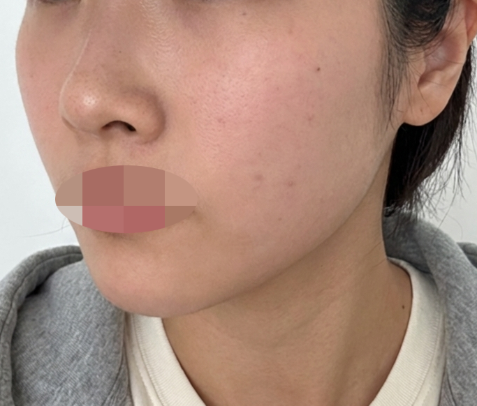 마취로 부담 없이 볼링크 첫 리프팅 받아봤어요!