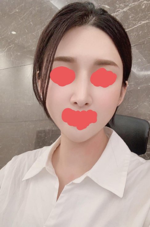 미용코 수술했어요~