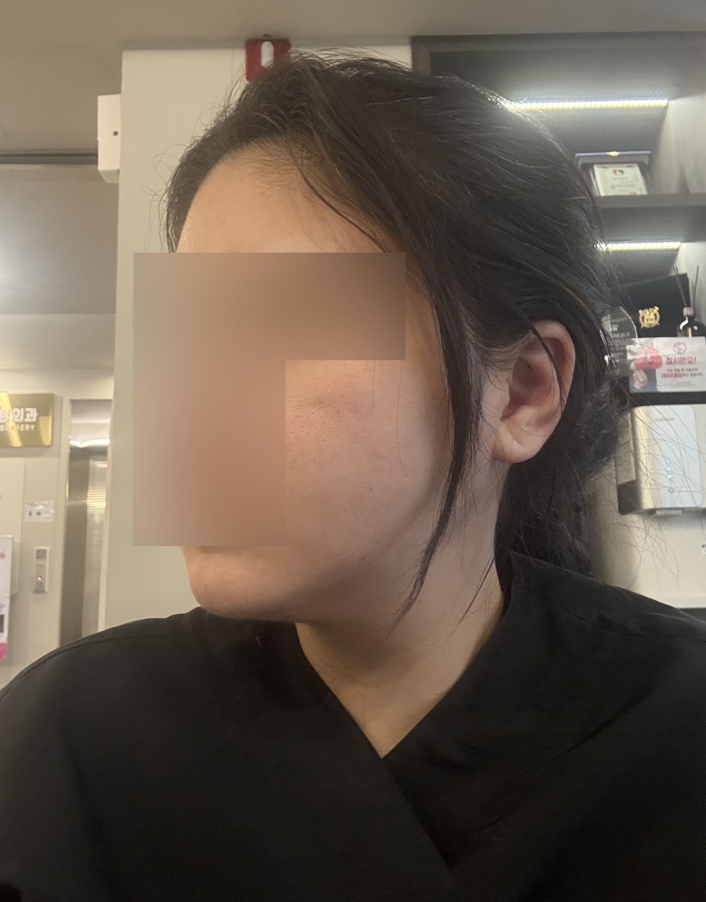 이중턱 턱라인 지방흡입 3개월, 주변에서 살 빠졌냐고 물어봐요
