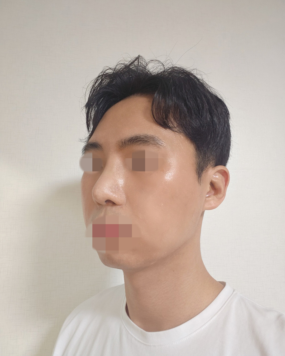 붓기가 계속 빠지고 있어서 코모양은 조금씩 더 변할거라고 하셨는데 당초 개선을 원했던 들창코나 코끝처짐이 개선되고 코끝이 오똑…