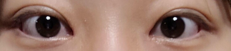 쌍수+눈교 한달 ㅎㅎ