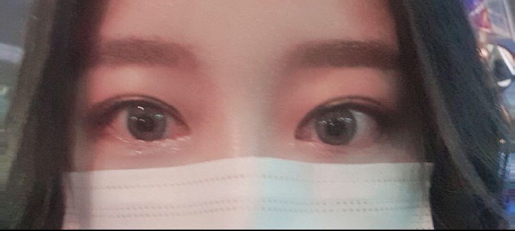 뒷트임 수술후기!!